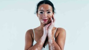 Vitiligo